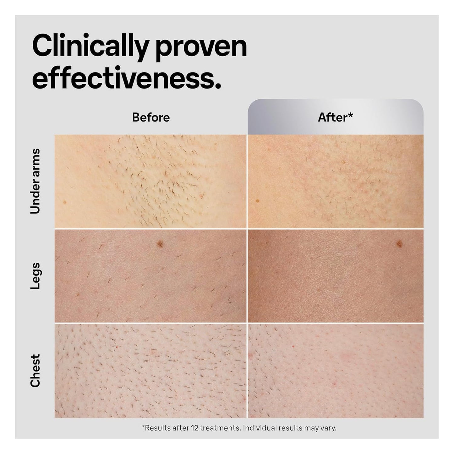 Braun IPL at Home Laser Hair Removal for Women and Men, Silk Expert Pro 5 PL5137 with Venus Swirl Razor, Permanent Visible Hair Reduction in Hair Regrowth for Body & Face, Corded, PL5137